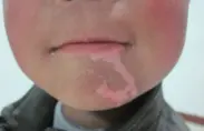 治疗图
