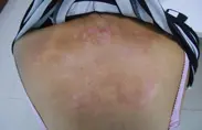 治疗图
