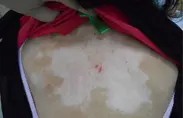 治疗图