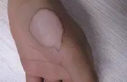 治疗图